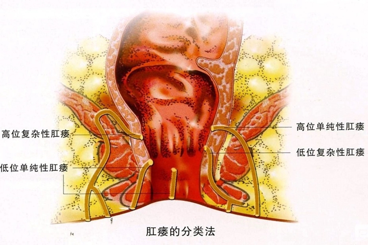 肛裂肛瘘手术治疗需要多长时间-肛裂肛瘘手术：虽有恐惧，但别怕，医生技术娴熟，恢复在望