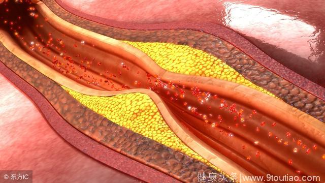 简述冠心病病人的护理措施-冠心病护理秘籍：察言观色、饮食把控、适量运动，让心脏享受温柔抚慰