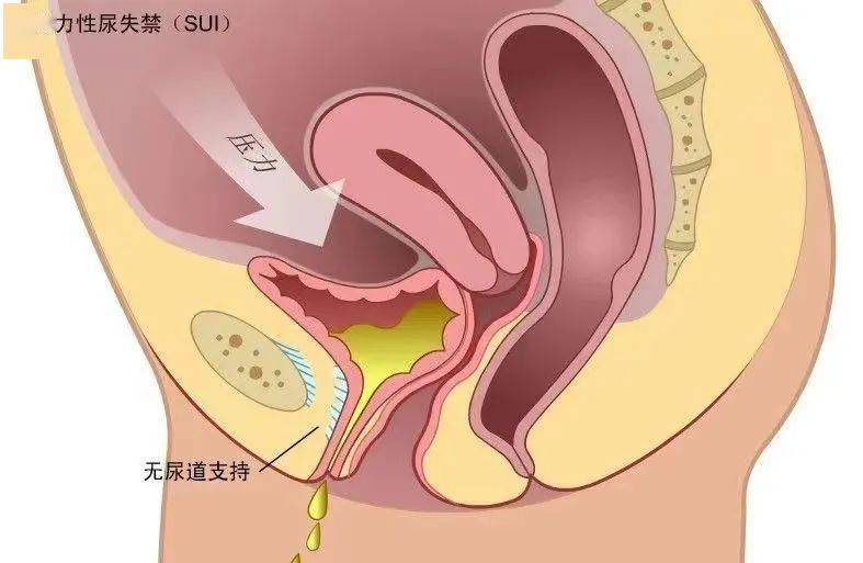 肛门失禁手术_肛门手术失禁原因_肛门手术后失禁