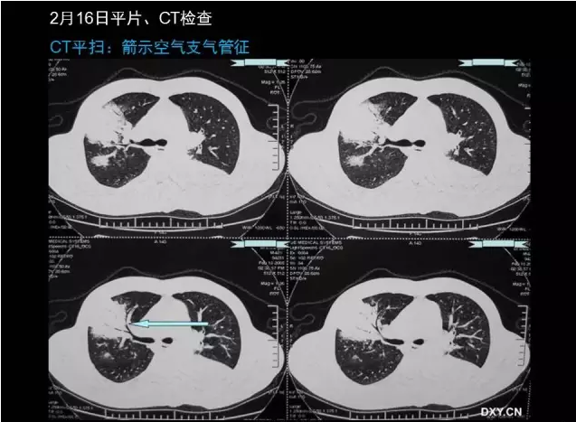 肺炎 c反应蛋白_肺炎蛋白质高怎么回事_肺炎c反应蛋白正常是什么肺炎