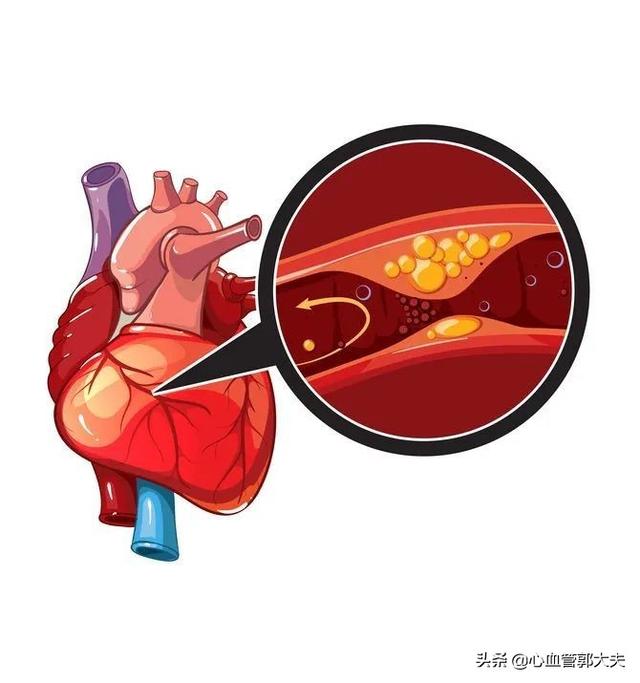 冠心病护理要点_护理冠心病要点是什么_护理冠心病患者的注意事项