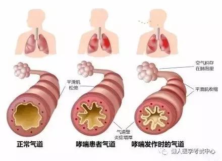 呼吸系统哮喘,了解、预防和治疗的关键