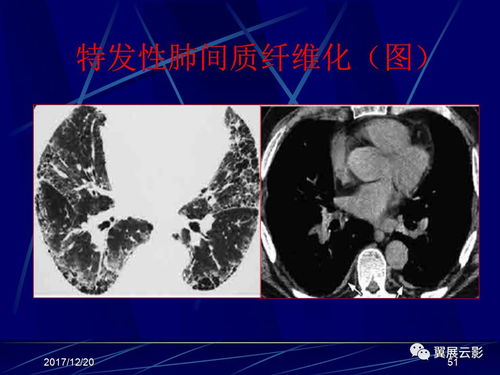 呼吸系统影像诊断学,呼吸系统影像诊断学的进展与挑战