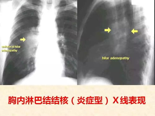 呼吸系统的常见疾病,呼吸系统常见疾病概述