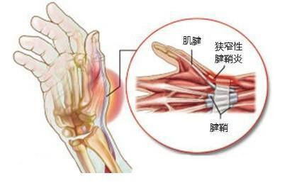 玩游戏腱鞘炎